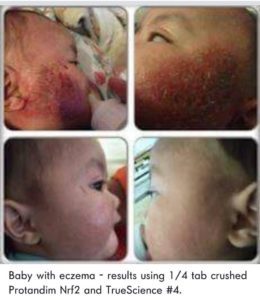 how this baby's eczema went away